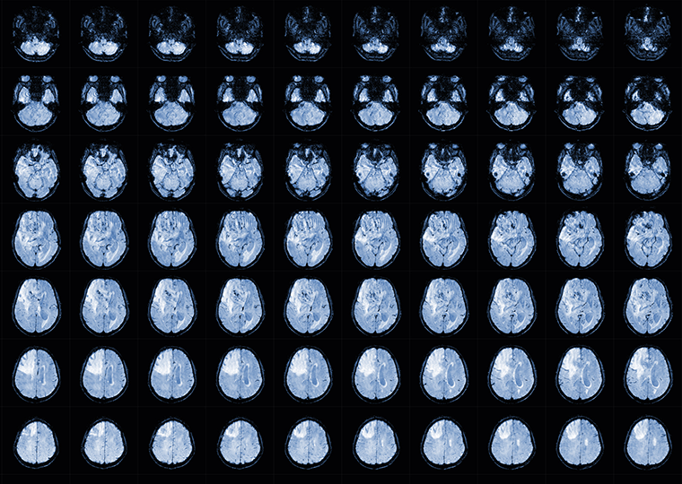 MRI Brain Axial views .to evaluate brain tumor.